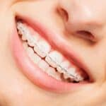 Clear (Ceramic) Braces - Portalupi Orthodontics - Woodland, CA