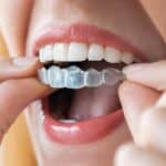 Invisalign Clear Aligners - Portalupi Orthodontics - Woodland, CA