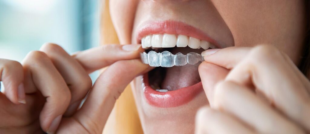 How Does Invisalign® Work? - Portalupi Orthodontics - Woodland, CA