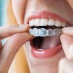 How Does Invisalign® Work? - Portalupi Orthodontics - Woodland, CA