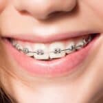 Self-ligating Braces - Portalupi Orthodontics - Woodland, CA