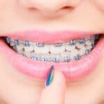 Traditional Metal Braces - Portalupi Orthodontics - Woodland, CA