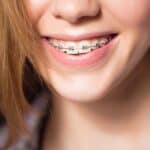 Traditional Metal Braces - Portalupi Orthodontics - Woodland, CA