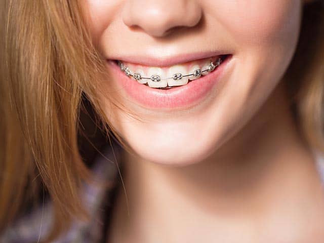 Traditional Metal Braces - Portalupi Orthodontics - Woodland, CA