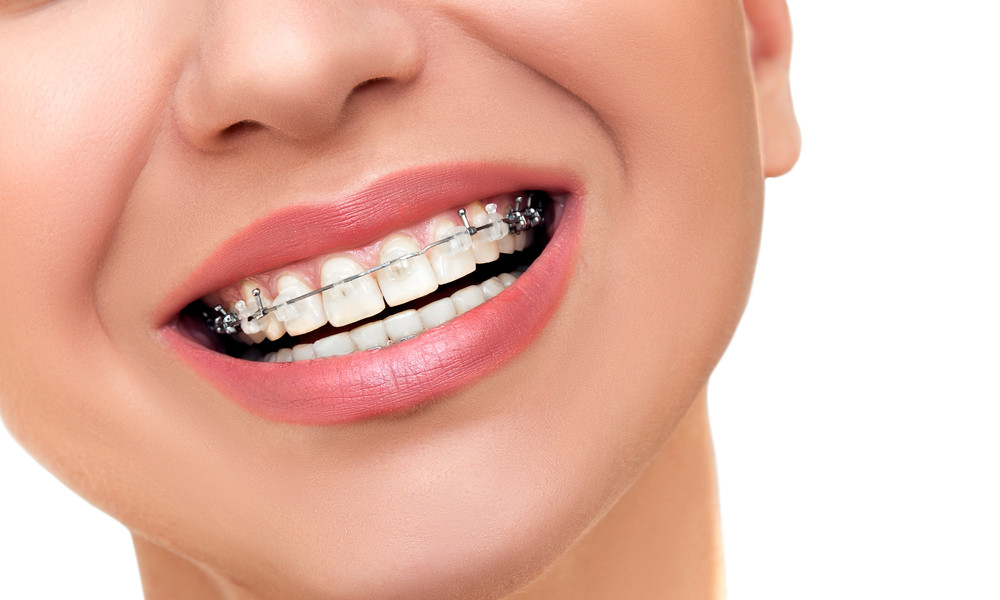 12 Things You Should Know Before Getting Braces