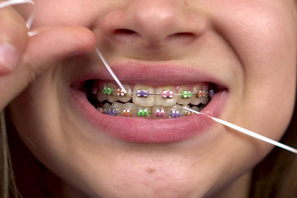 5 Tips for Fresh Breath with Braces