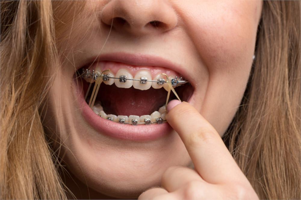 What are Elastic Bands for Braces? How to Put Elastic Rubber Bands On.